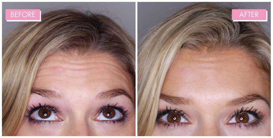 face-lift-2 Botox