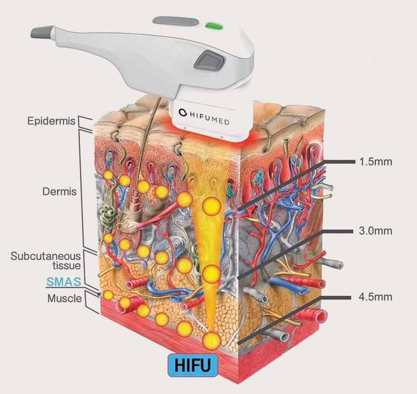 hifu-3