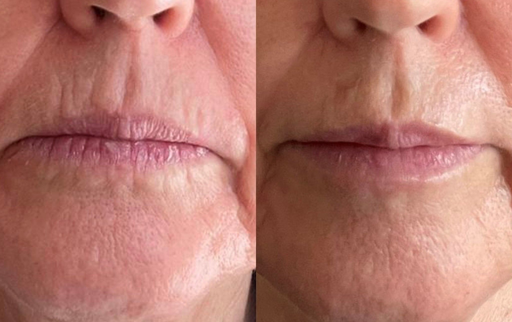 lips+before+and+after