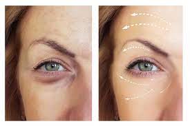 mesotherapy eye booster Mesotherapy Eye Treatment